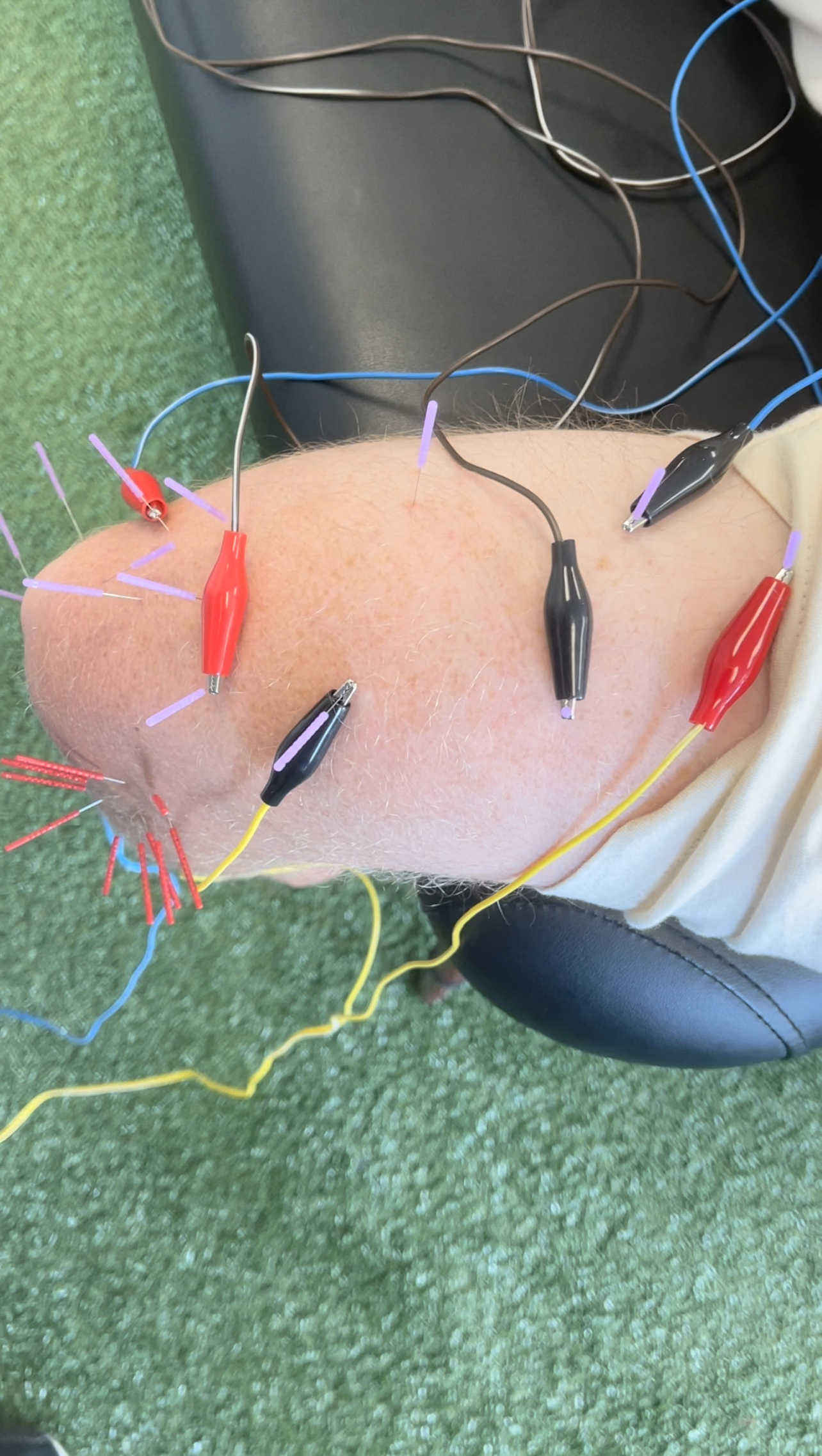 3 Reasons to Get Dry Needling for Tendonitis