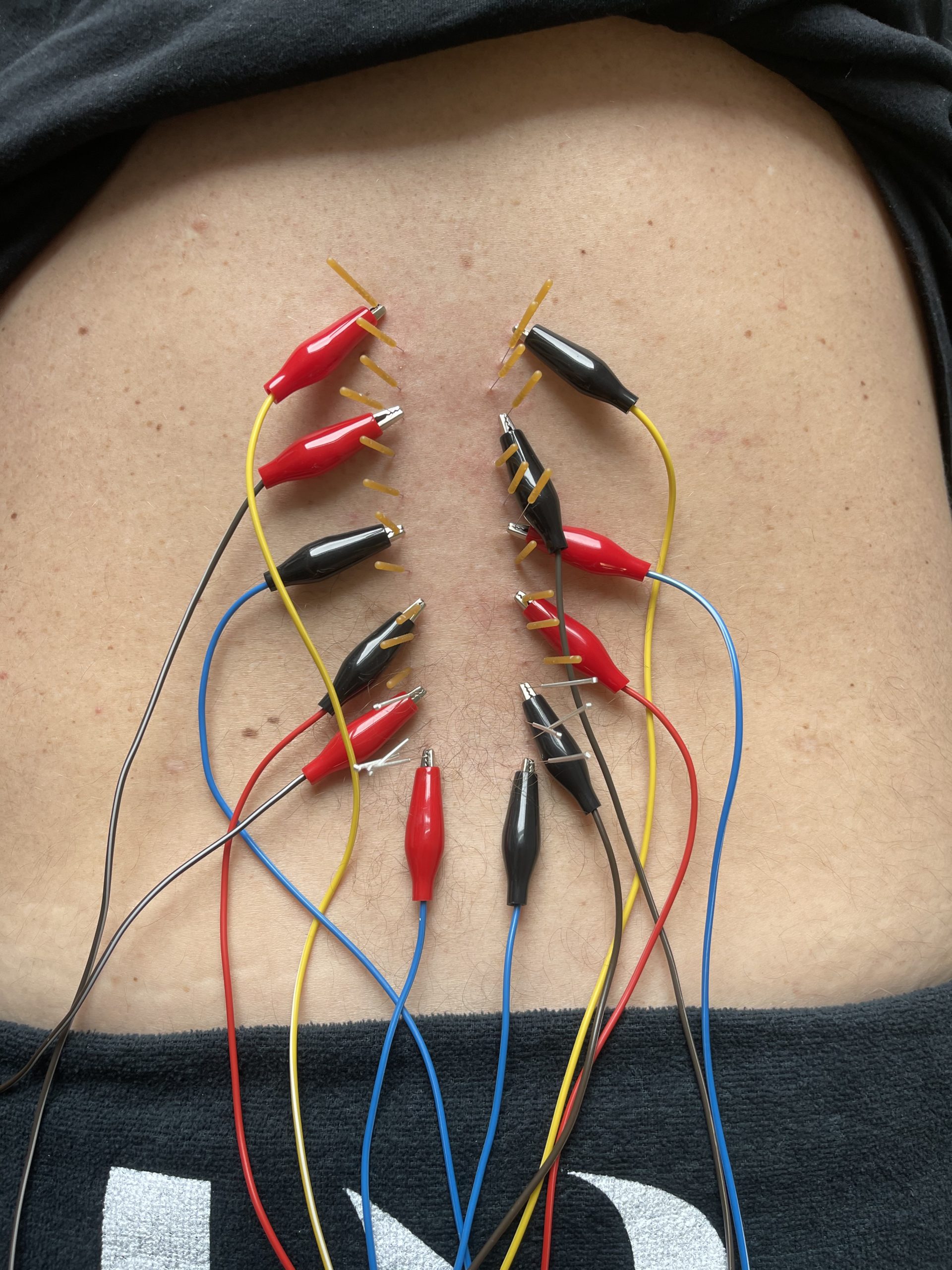 Can Dry Needling Help My Sciatica?