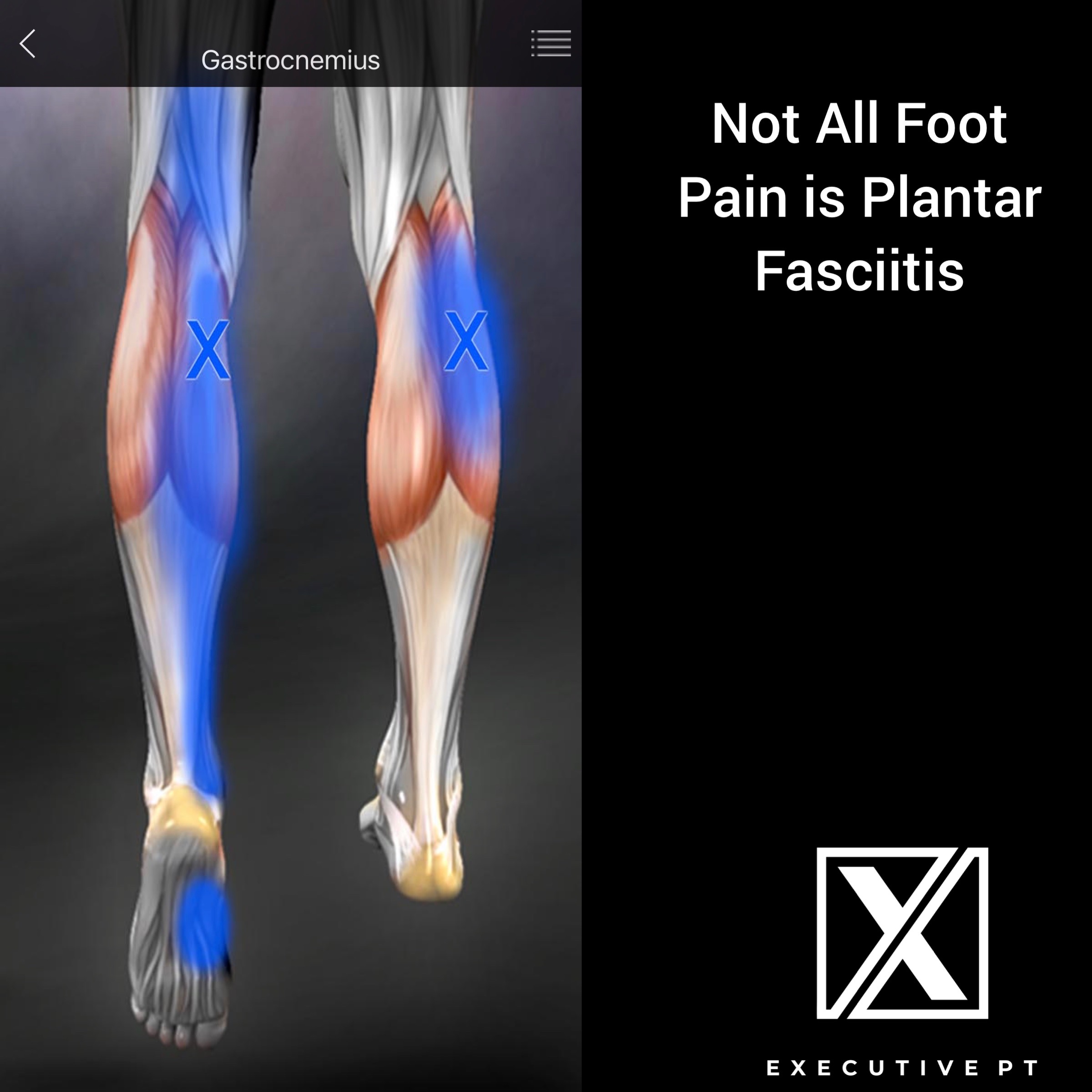 Not All Foot Pain is Plantar Fasciitis